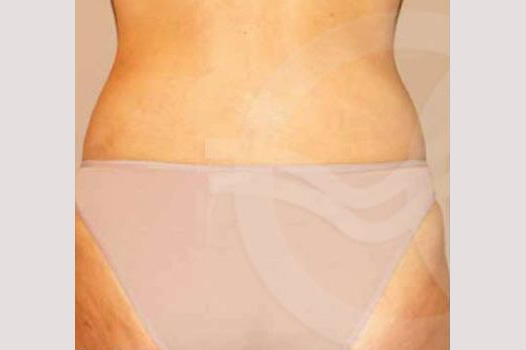 Gesäßvergrößerung BRAZILIAN BUTT LIFT ante/post-op I