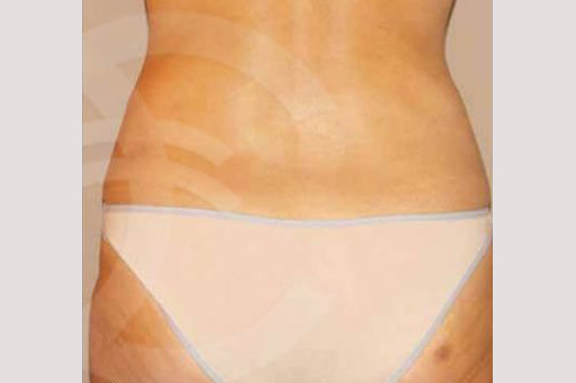 Gesäßvergrößerung BRAZILIAN BUTT LIFT ante/post-op I