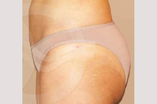 Buttock Augmentation BRAZILIAN BUTT LIFT ante/post-op II