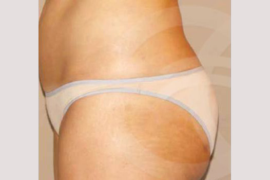 Gesäßvergrößerung BRAZILIAN BUTT LIFT ante/post-op II