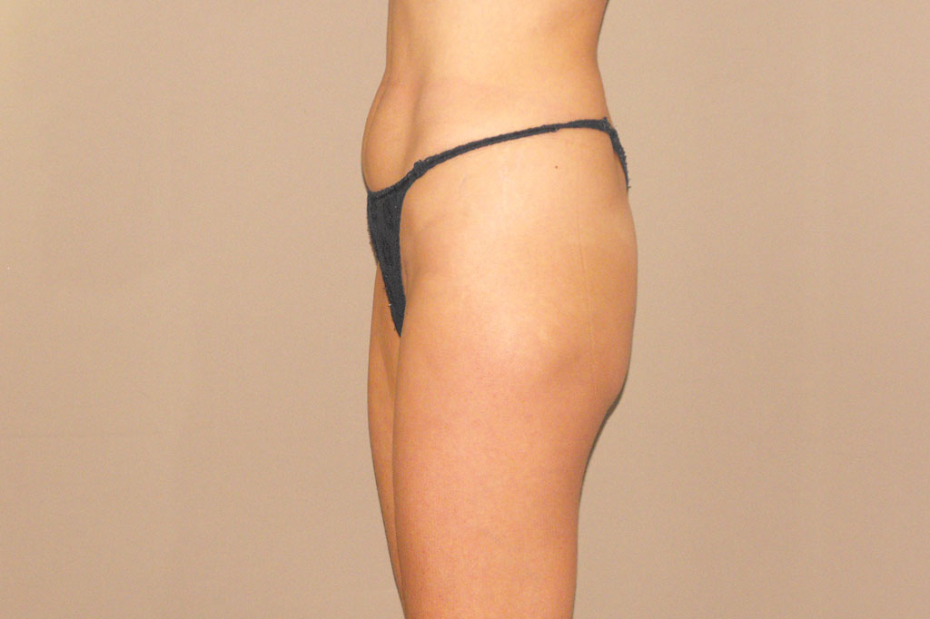 Photos Buttock Augmentation  ante/post-op II