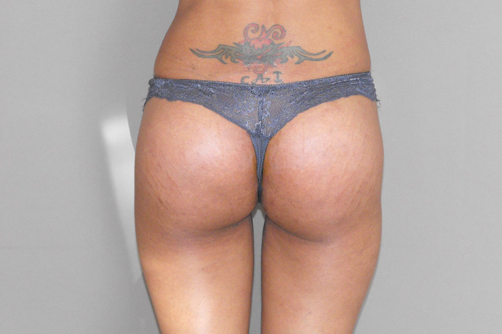 Buttock Augmentation BUTT UPLIFT ante/post-op I