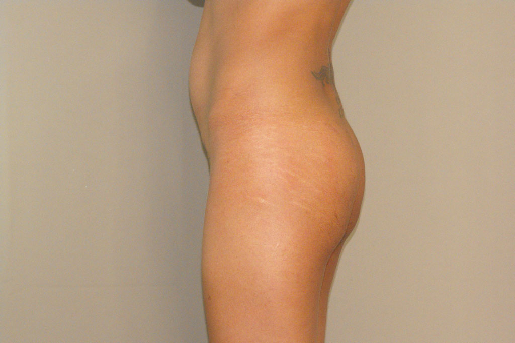 Buttock Augmentation BUTT UPLIFT ante/post-op III