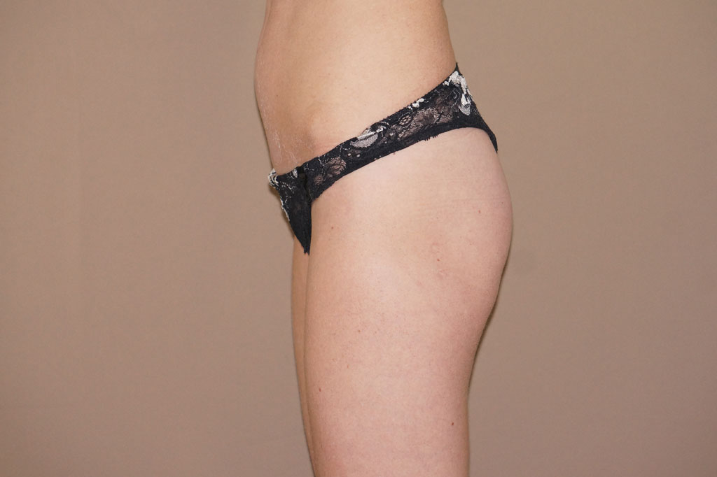 Buttock Augmentation Gluteal implants ante-op lateral