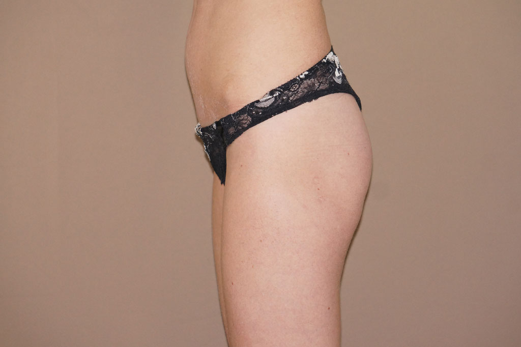 Buttock Augmentation Gluteal implants ante/post-op II