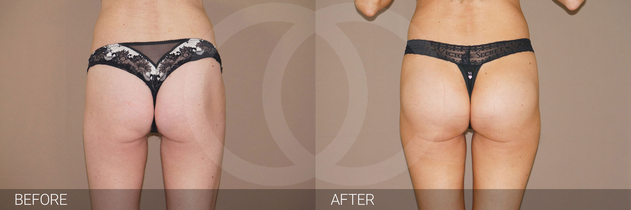 Buttock Augmentation Gluteal implants ante/post-op I