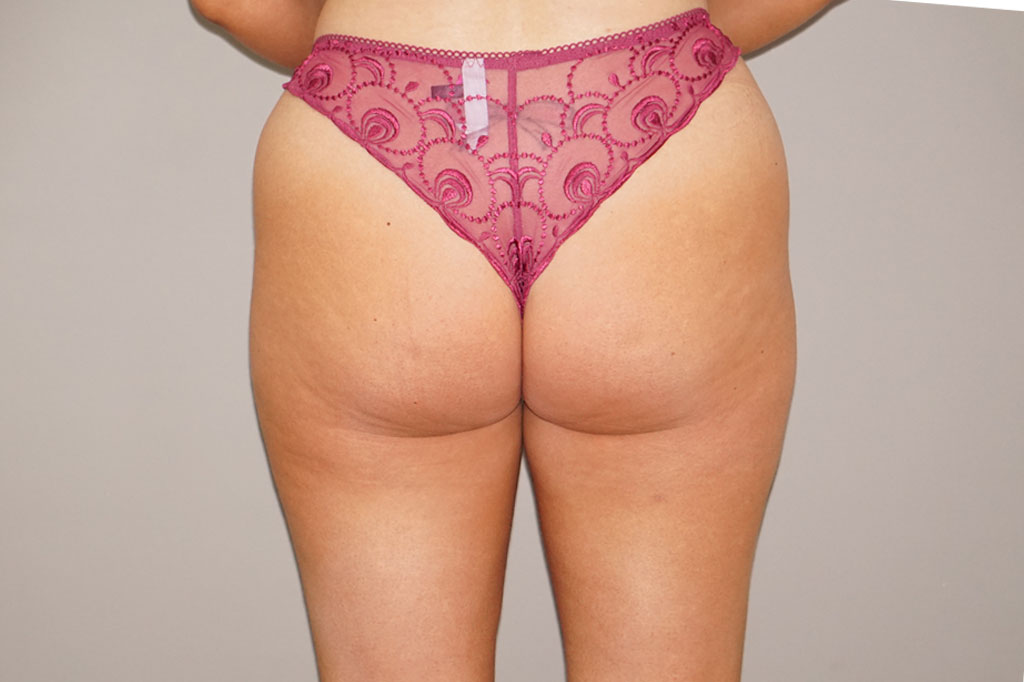 Buttock Augmentation Gluteal Fat Grafting BBL ante/post-op I