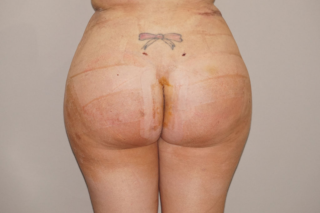 Buttock Augmentation Gluteal Fat Grafting BBL post-op profil