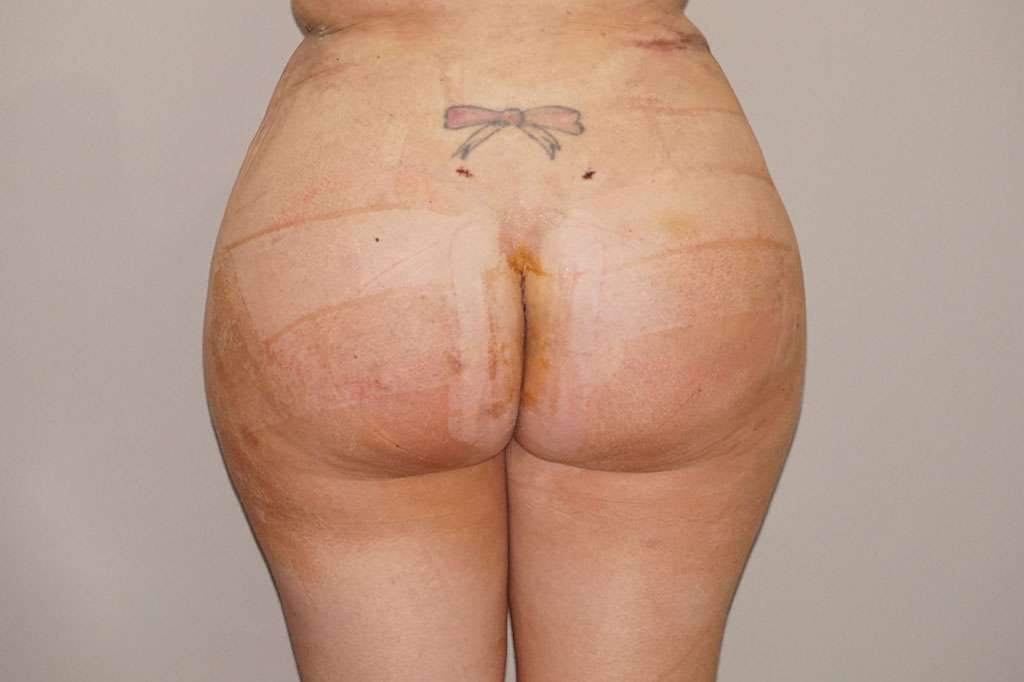 Augmentation des Fesses 5 post-op profil