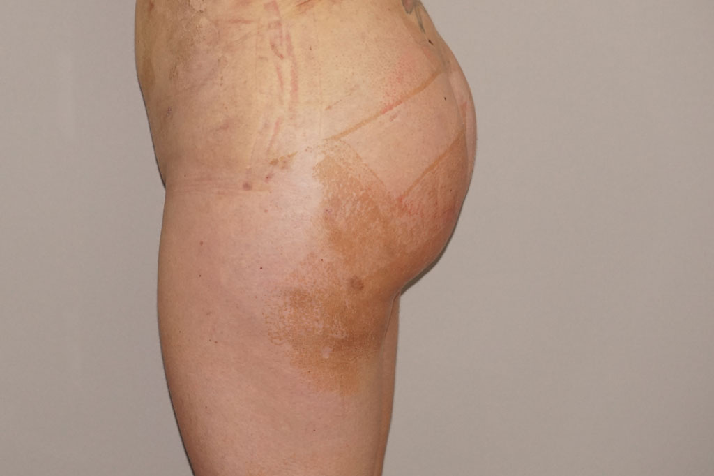 Buttock Augmentation Gluteal Fat Grafting BBL ante/post-op II