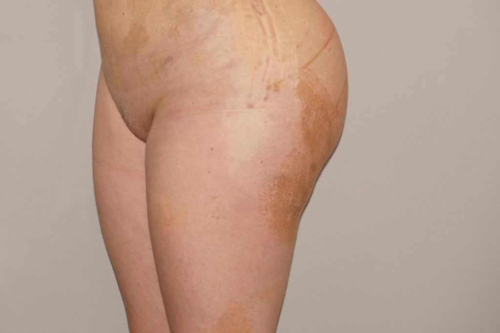 Buttock Augmentation Gluteal Fat Grafting BBL ante/post-op III