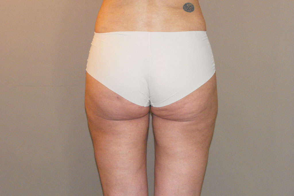 Gesäßvergrößerung Brazilian Butt Lift ante/post-op I