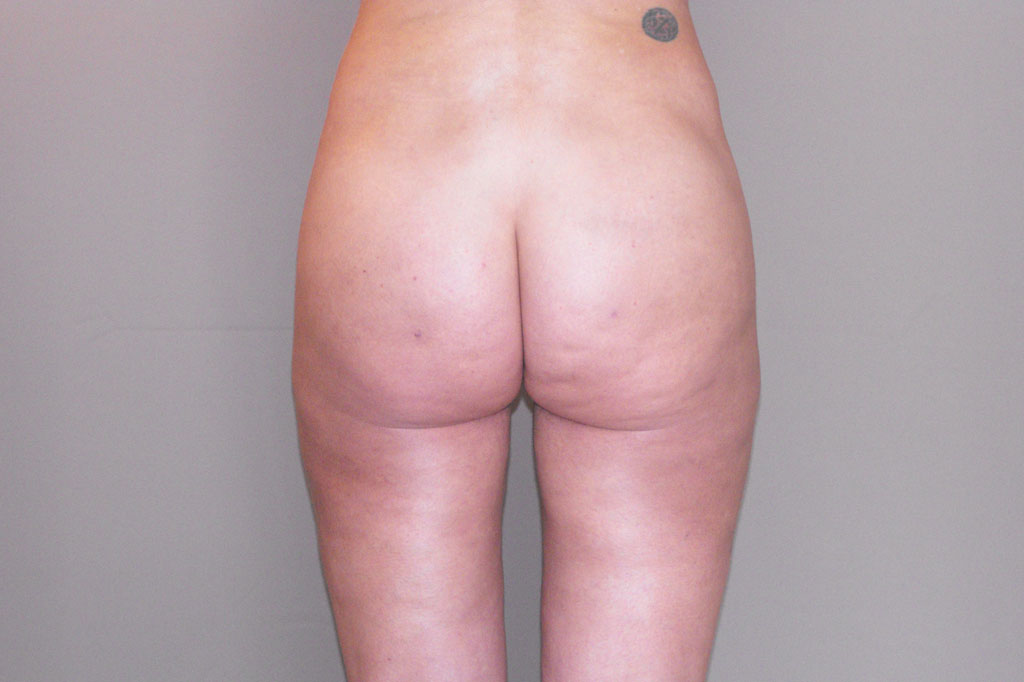 Buttock Augmentation BBL Brazilian Butt Lift ante/post-op I