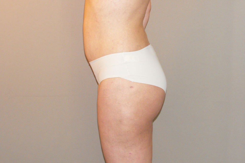 Buttock Augmentation BBL Brazilian Butt Lift ante/post-op II