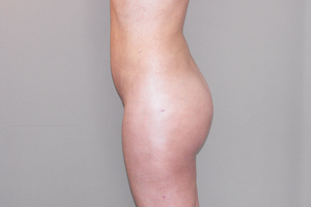 Augmentation des Fesses 6 post-op lateral