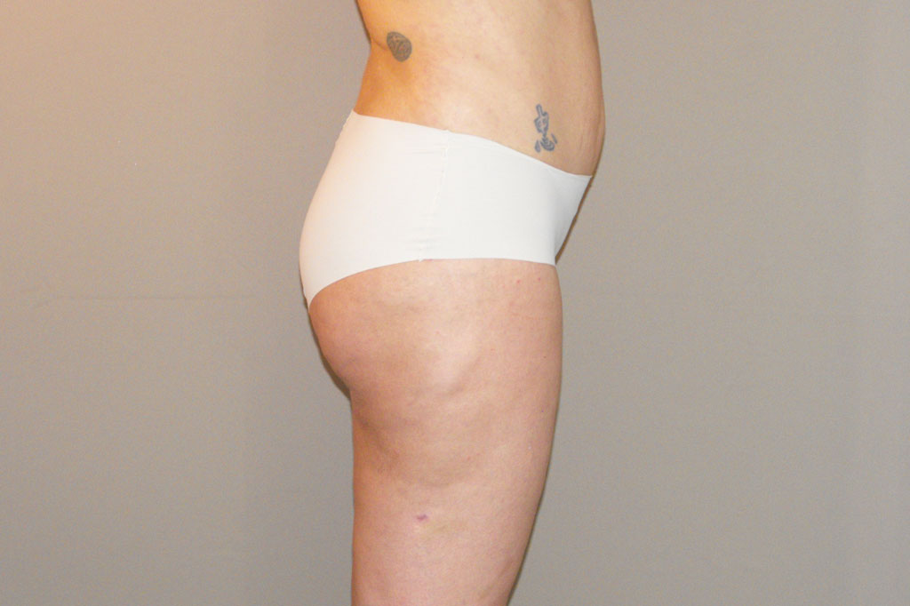 Buttock Augmentation BBL Brazilian Butt Lift ante/post-op III