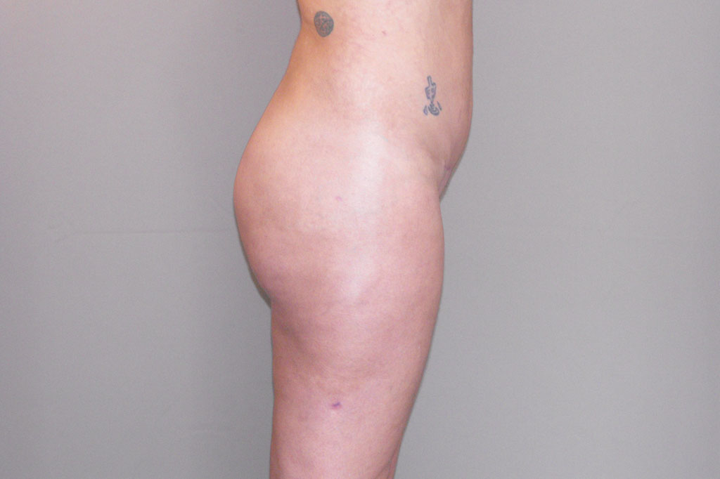 Augmentation des Fesses 6 post-op retro/lateral