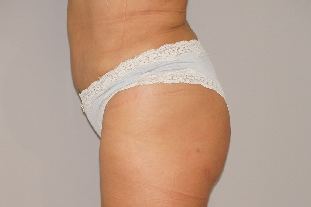 Buttock Augmentation BBL Fat transfer post-op lateral