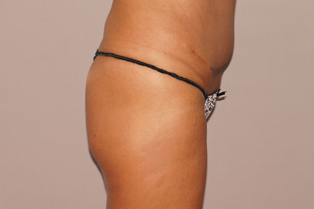 Buttock Augmentation BBL Fat transfer ante/post-op III