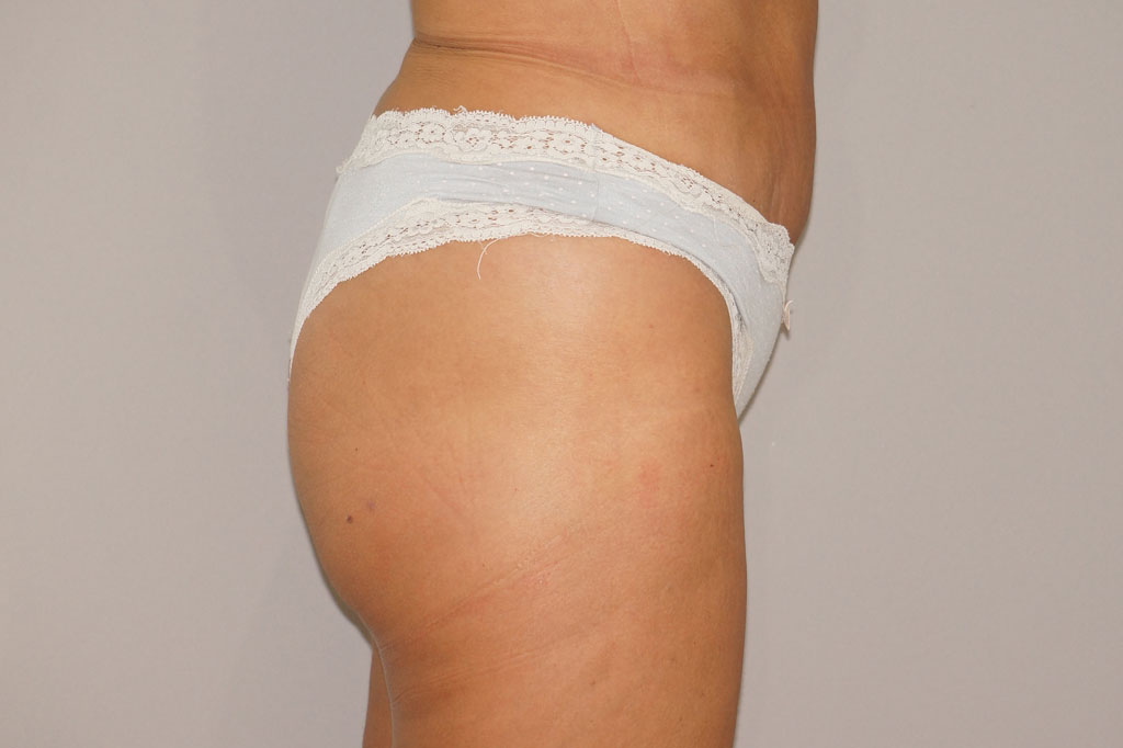 Buttock Augmentation BBL Fat transfer ante/post-op III