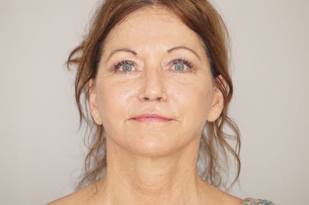 Fat grafting Fat transfer to face ante/post-op I