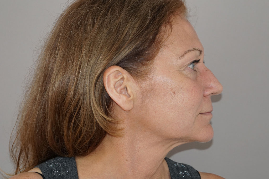 Injertos de grasa Lipofilling de la cara ante-op retro/lateral