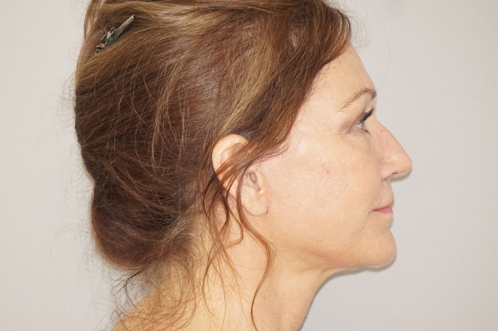 Körperfetttransplantation PAVE Gesichtslift post-op retro/lateral