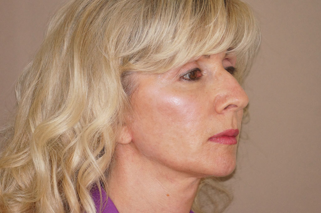 Injertos de grasa Lipofilling facial post-op lateral