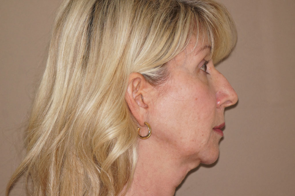 Injertos de grasa Lipofilling facial ante-op retro/lateral