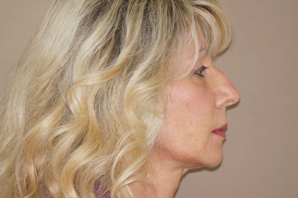 Injertos de grasa Lipofilling facial post-op retro/lateral