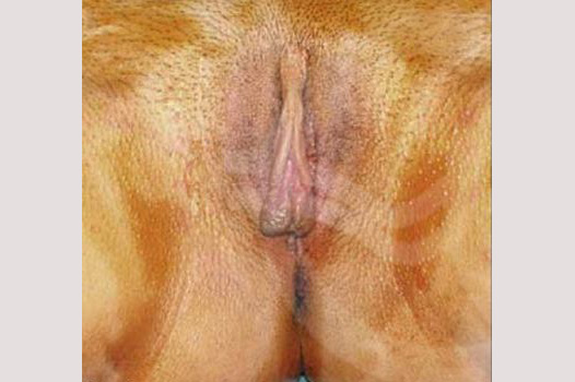 Labioplastia Rejuvenecimiento vaginal ante-op profil
