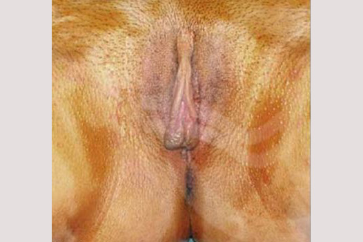 Photos Labiaplasty  ante/post-op I