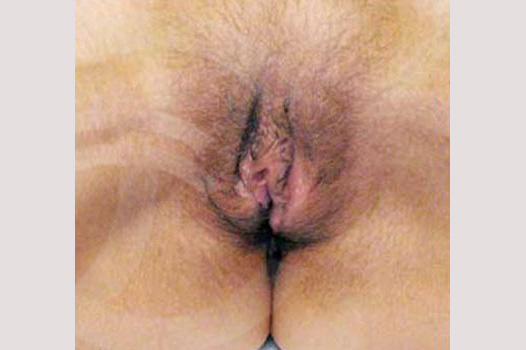Photos Labiaplasty  ante/post-op I