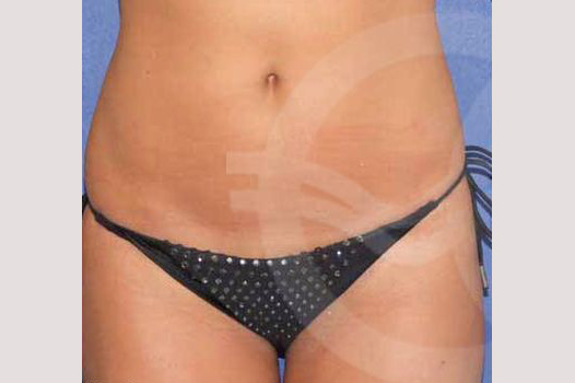 Liposuction LIPOSCULPTURE ante/post-op I