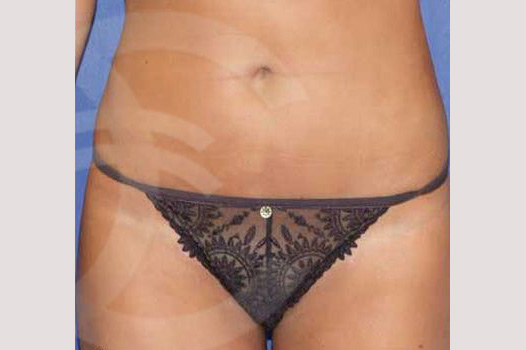 Liposuction LIPOSCULPTURE ante/post-op I