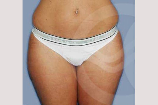 Photos Liposuction  ante/post-op I