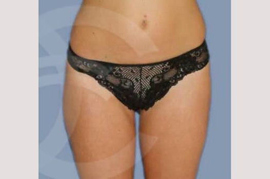 Photos Liposuction  ante/post-op I