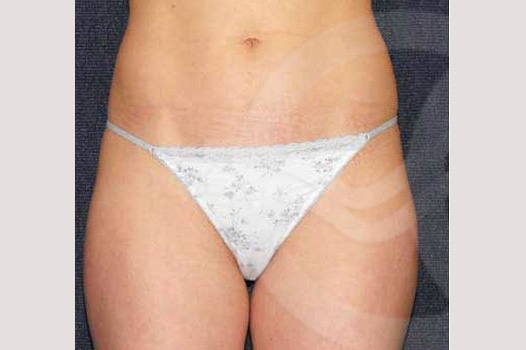 Fotos Liposucción  ante/post-op I