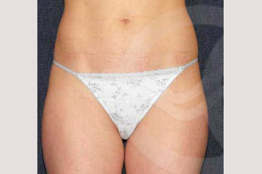 Liposuction INNER AND OUTER THIGHS ante/post-op I