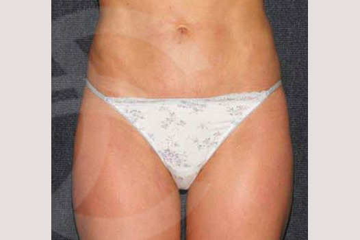 Liposuction INNER AND OUTER THIGHS ante/post-op I