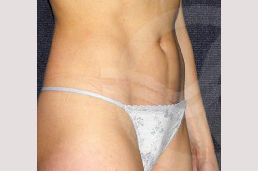 Liposuction INNER AND OUTER THIGHS ante/post-op II