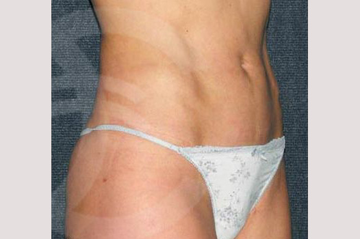 Liposuction INNER AND OUTER THIGHS ante/post-op II