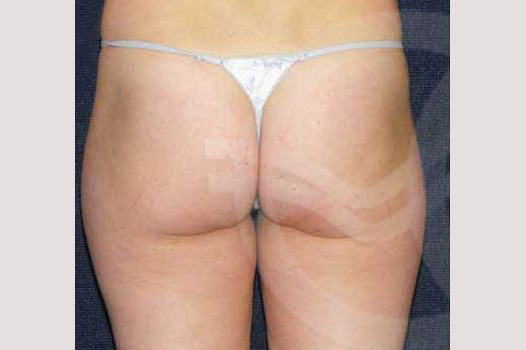 Liposuction INNER AND OUTER THIGHS ante/post-op III