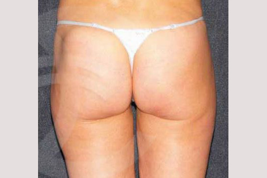 Liposuction INNER AND OUTER THIGHS ante/post-op III