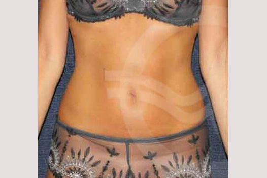 Photos Liposuction  ante/post-op I