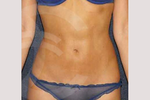 Liposuction LOVE HANDLES ante/post-op I