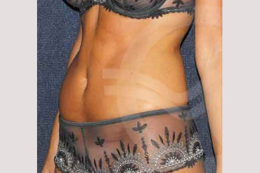 Photos Liposuction  ante/post-op II