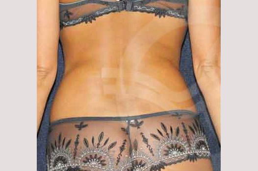Photos Liposuction  ante/post-op III