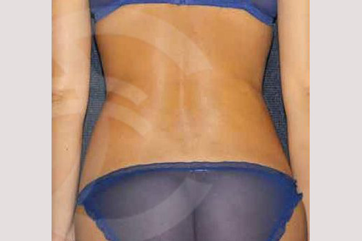 Liposuction LOVE HANDLES ante/post-op III