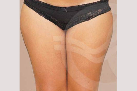 Liposuction HIPS INNER AND OUTER THIGHS ante/post-op I